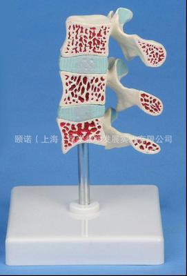 骨质疏松症模型 医药教学的破冰利器